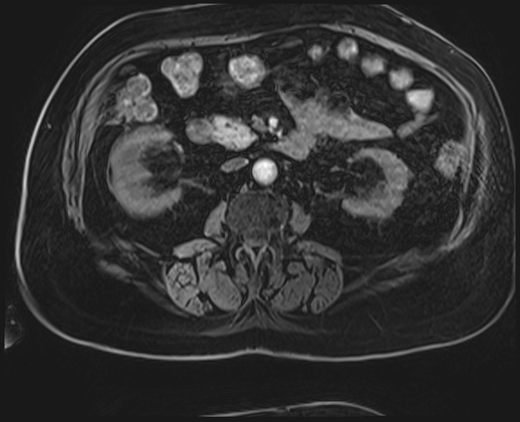 Adrenal cortical carcinoma (Radiopaedia 64017-72770 H 28).jpg