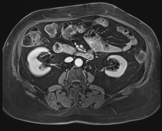 Adrenal cortical carcinoma (Radiopaedia 64017-72770 K 49).jpg