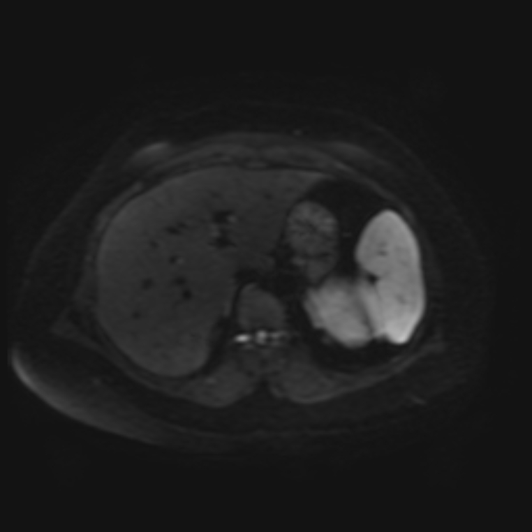 Adrenal cortical carcinoma (Radiopaedia 70906-81116 Axial DWI 7).jpg