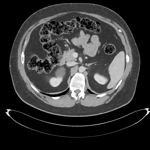 File:Adrenal cyst (Radiopaedia 45625-49778 AXIAL THICK 60 sec 26).png