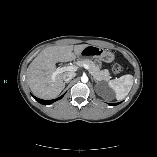Adrenal cystic lymphangioma (Radiopaedia 83161-97534 Axial C+ arterial phase 29).jpg