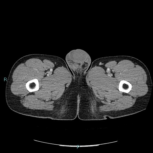 Adrenal cystic lymphangioma (Radiopaedia 83161-97534 Axial C+ portal venous phase 116).jpg