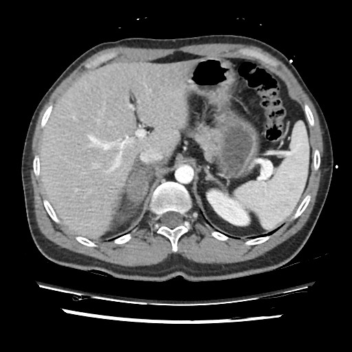 File:Adrenal gland trauma (Radiopaedia 81351-95078 Axial Dual bolus trauma C+ 61).jpg