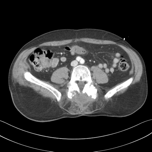 File:Adrenal hematoma (Radiopaedia 44334-47968 Axial C+ portal venous phase 50).png