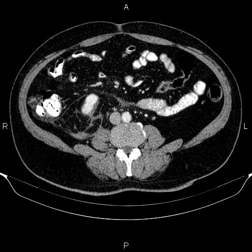 Adrenal hemorrhage (Radiopaedia 62622-70916 Axial C+ portal venous phase 111).jpg