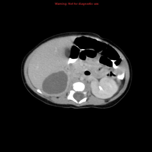 File:Adrenal hemorrhage (Radiopaedia 9390-10077 Axial C+ portal venous phase 10).jpg