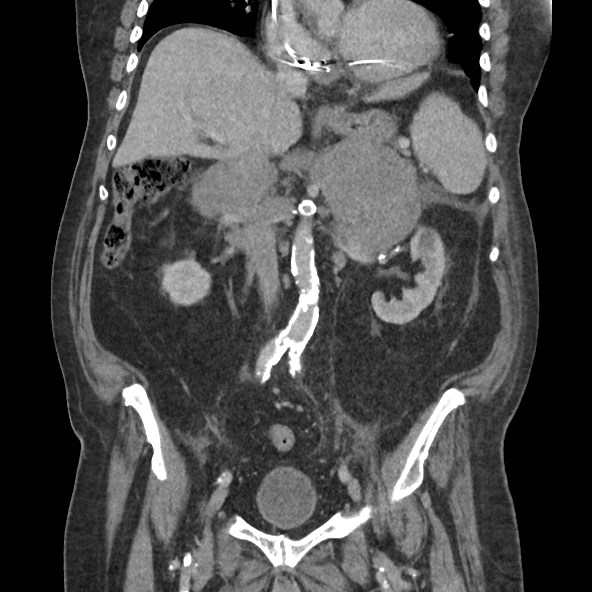 Adrenal lymphoma (Radiopaedia 84145-99415 Coronal C+ portal venous phase 43).jpg