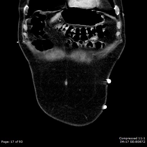 Adrenal metastasis (Radiopaedia 78425-91079 Sagittal C+ portal venous phase 4).jpg