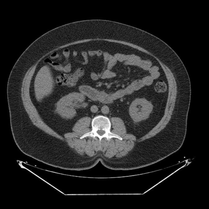 Adrenal myelolipoma (Radiopaedia 26278-26407 Axial non-contrast 34).jpg
