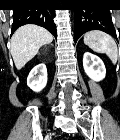 File:Adrenal myelolipoma (Radiopaedia 82742-96986 Coronal renal cortical phase 54).jpg