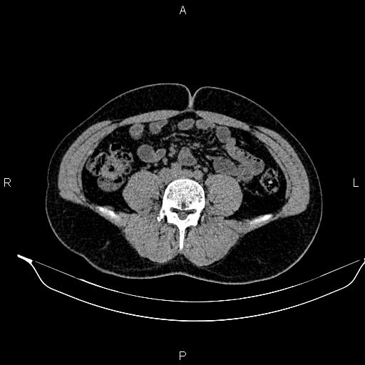 File:Adrenal myelolipoma (Radiopaedia 87794-104246 Axial non-contrast 66).jpg