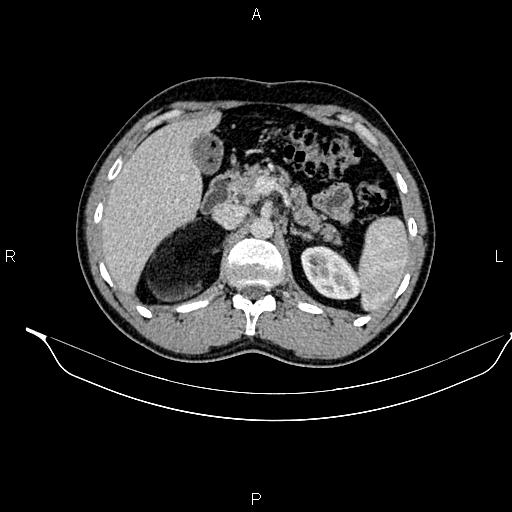 Adrenal myelolipoma (Radiopaedia 87794-104246 Axial renal cortical phase 35).jpg
