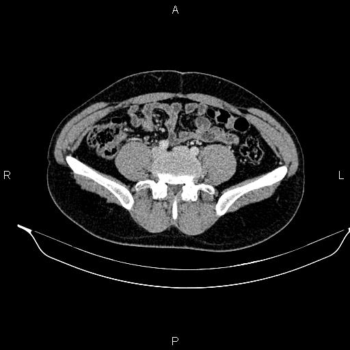Adrenal myelolipoma (Radiopaedia 87794-104246 Axial renal cortical phase 71).jpg