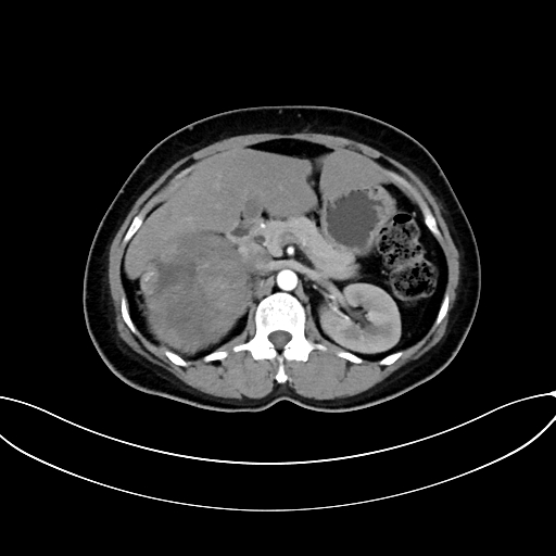 Adrenocortical carcinoma (Radiopaedia 87281-103569 Axial C+ arterial phase 33).jpg