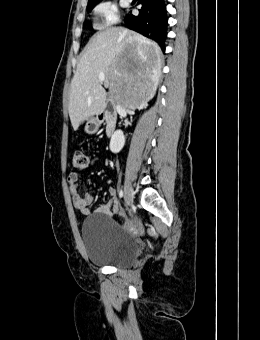 Adrenocortical carcinoma (Radiopaedia 87281-103569 Sagittal C+ portal venous phase 112).jpg