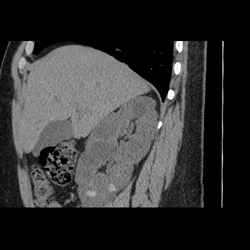 Adult polycystic kidney disease (Radiopaedia 59075-66368 Sagittal non-contrast 19).jpg