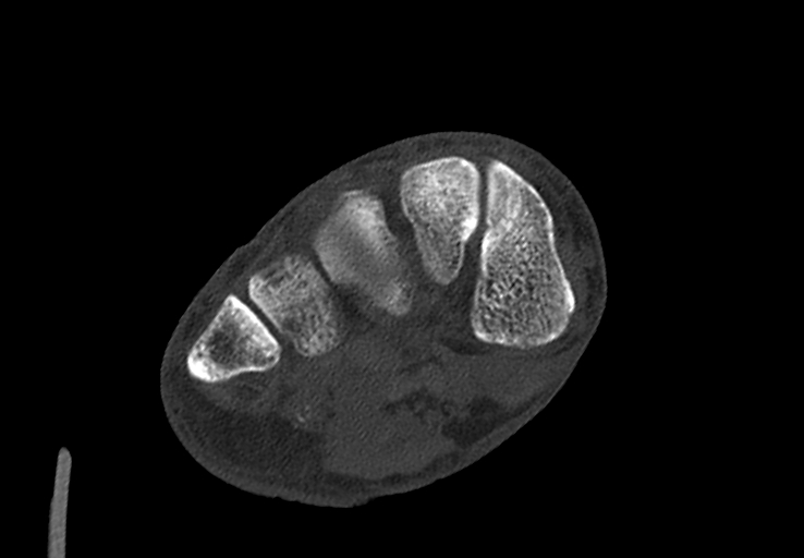 Advanced osteomyelitis due to open metatarsal fracture (Radiopaedia 83891-99095 Axial bone window 25).jpg