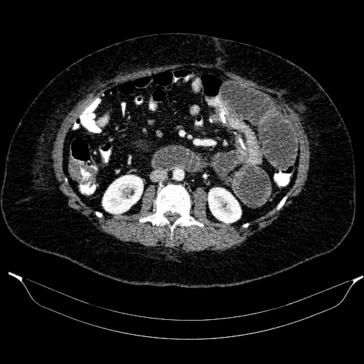 Afferent loop syndrome - secondary to incarcerated trocar site hernia (Radiopaedia 82959-97305 Axial C+ portal venous phase 113).jpg