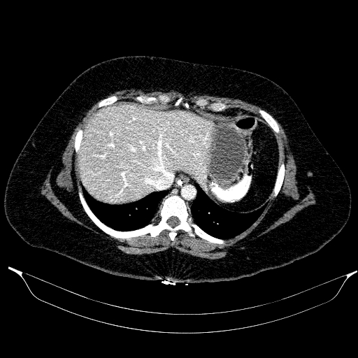 Afferent loop syndrome - secondary to incarcerated trocar site hernia (Radiopaedia 82959-97305 Axial C+ portal venous phase 33).jpg