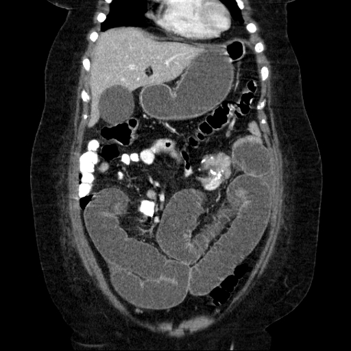 File:Afferent loop syndrome - secondary to incarcerated trocar site hernia (Radiopaedia 82959-97305 Coronal C+ portal venous phase 53).jpg