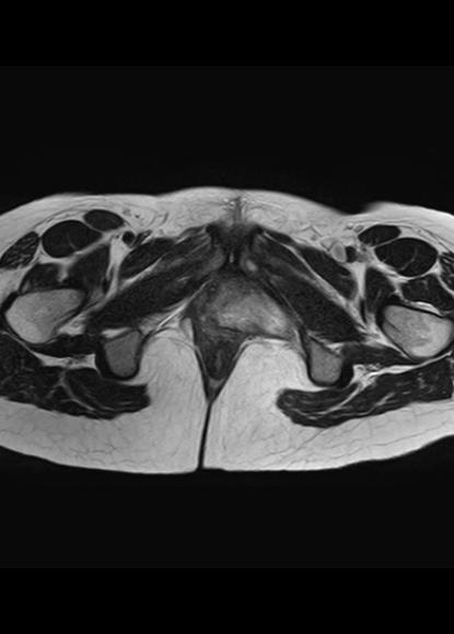 File:Aggressive angiomyxoma of the pelvis and perineum (Radiopaedia 59162-66479 Axial T2 1).jpg