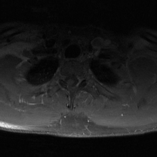 File:Aggressive vertebral hemangioma (Radiopaedia 39937-42404 Axial T1 C+ fat sat 37).png