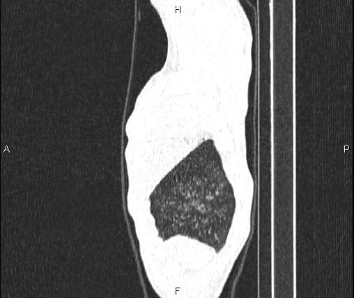 Air bronchogram in pneumonia (Radiopaedia 85719-101512 Sagittal lung window 8).jpg