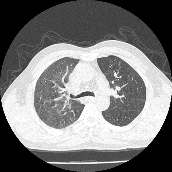 Airway foreign body in adult (Radiopaedia 85907-101779 Axial lung window 54).jpg