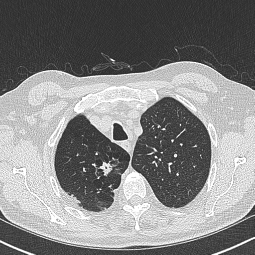 Allergic bronchopulmonary aspergillosis (Radiopaedia 44760-48571 Axial lung window 13).png