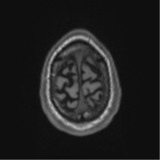 Alzheimer's disease- with Gerstmann syndrome and dressing apraxia (Radiopaedia 54882-61150 Axial T1 69).png