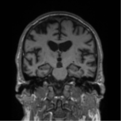 Alzheimer's disease- with Gerstmann syndrome and dressing apraxia (Radiopaedia 54882-61150 Coronal T1 46).png