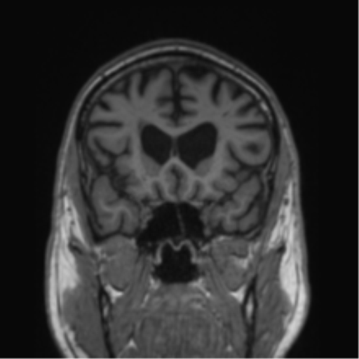 Alzheimer's disease- with Gerstmann syndrome and dressing apraxia (Radiopaedia 54882-61150 Coronal T1 62).png
