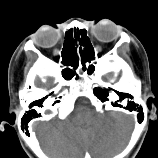 File:Ameloblastoma (Radiopaedia 26645-26793 Axial C+ delayed 38).jpg