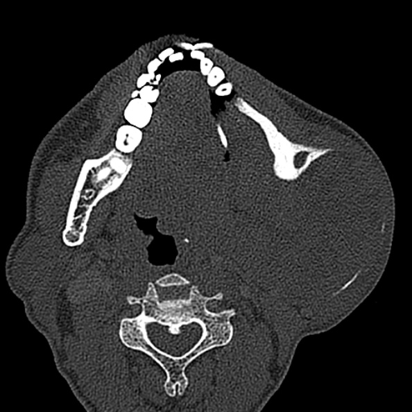 Ameloblastoma (Radiopaedia 51921-57766 Axial bone window 71).jpg