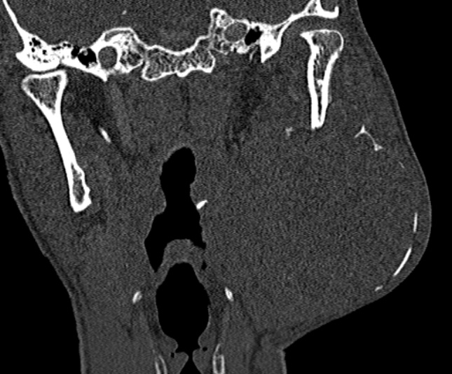 Ameloblastoma (Radiopaedia 51921-57766 Coronal bone window 181).jpg