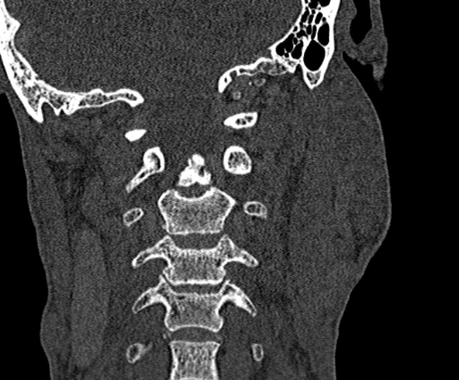 Ameloblastoma (Radiopaedia 51921-57766 Coronal bone window 247).jpg