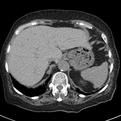 File:Amiodarone-induced pulmonary fibrosis (Radiopaedia 82355-96460 Axial non-contrast 54).jpg