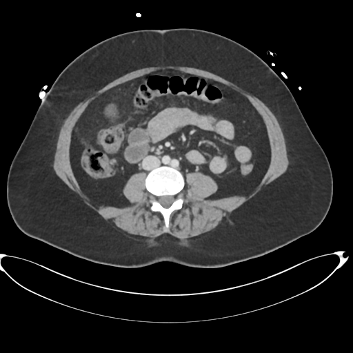 File:Amoebic liver abscess (Radiopaedia 52611-58530 A 58).png