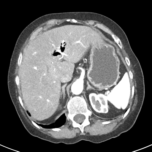 File:Ampullary adenocarcinoma (Radiopaedia 34013-35237 B 17).png
