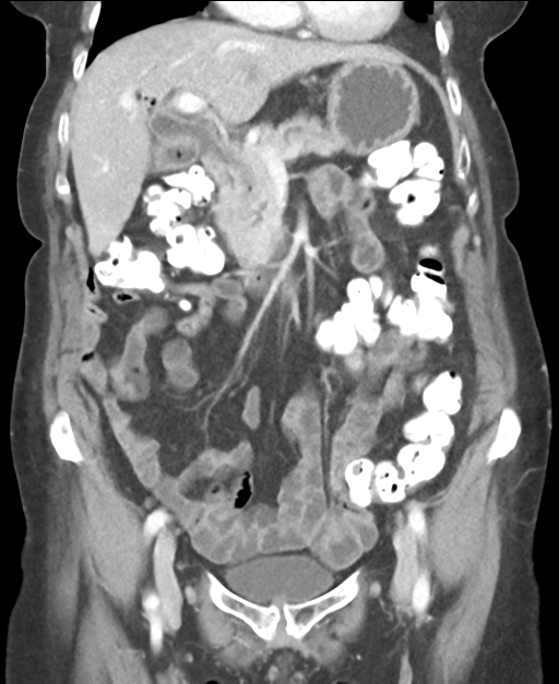Ampullary adenocarcinoma (Radiopaedia 34013-35237 E 21).png