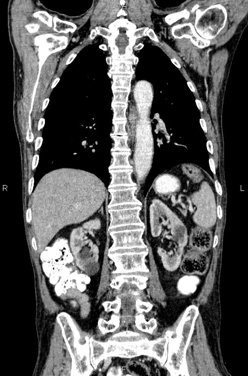 Ampullary adenocarcinoma (Radiopaedia 86093-102033 D 41).jpg