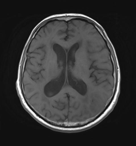 File:Amyloid angiopathy with inflammation (Radiopaedia 30360-31002 Axial T1 19).jpg
