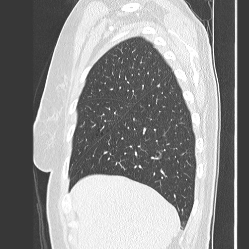 File:Amyloidosis - bronchial and diffuse nodular pulmonary involvement (Radiopaedia 60156-67745 Sagittal lung window 16).jpg