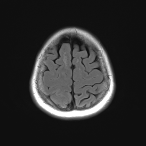 File:Anaplastic astrocytoma (Radiopaedia 86943-103160 Axial FLAIR 24).png