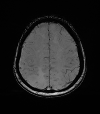 Anaplastic astrocytoma (Radiopaedia 86943-103160 Axial SWI 68).png