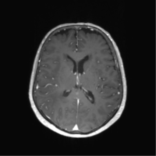 File:Anaplastic astrocytoma (Radiopaedia 86943-103160 Axial T1 C+ 37).png