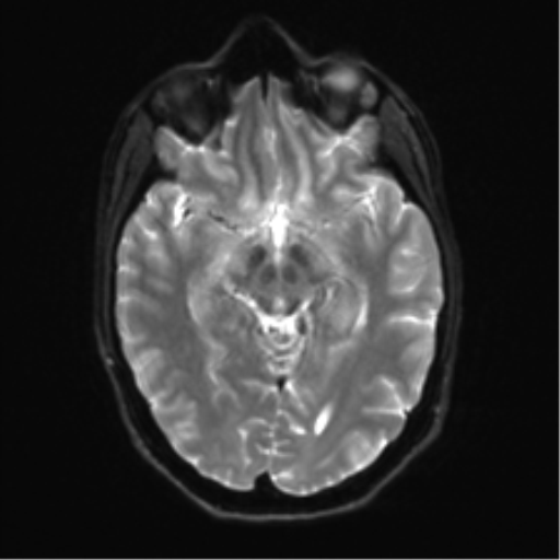 Anaplastic astrocytoma IDH mutant (Radiopaedia 50046-55341 Axial DWI 12).png