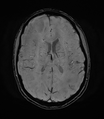 File:Anaplastic astrocytoma IDH mutant (Radiopaedia 50046-55341 Axial SWI 53).png