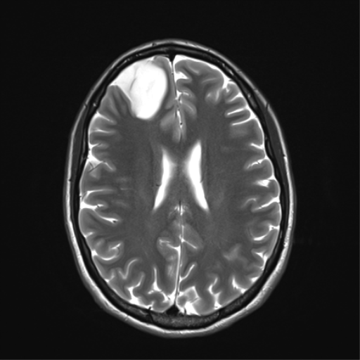 File:Anaplastic astrocytoma IDH mutant (Radiopaedia 50046-55341 Axial T2 25).png