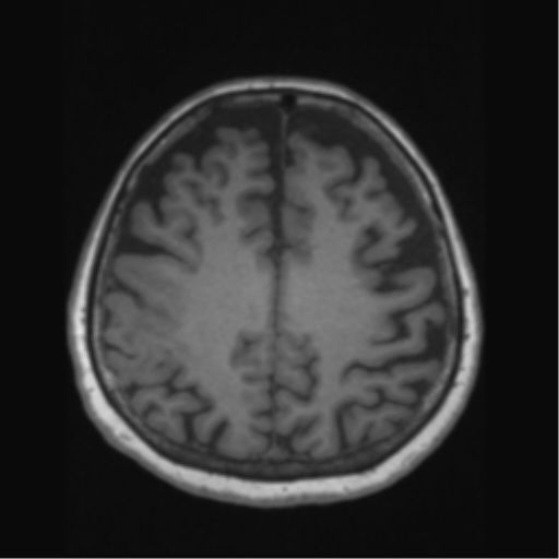 File:Anaplastic astrocytoma IDH wild-type (pseudoprogression) (Radiopaedia 42209-45276 Axial T1 106).png